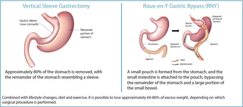diagram of vertical sleeve gastrectomy and roux-en-Y gastric bypass